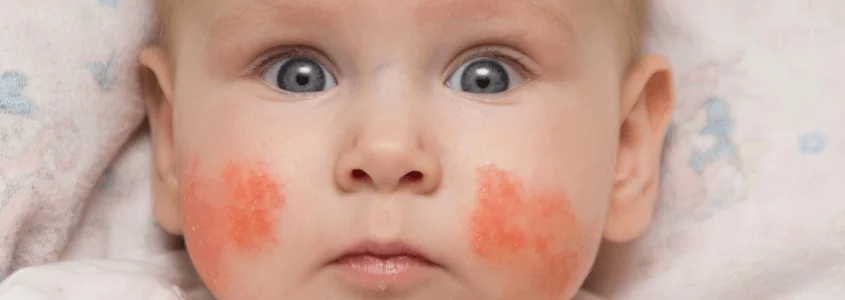 Atopik Dermatit Egzama