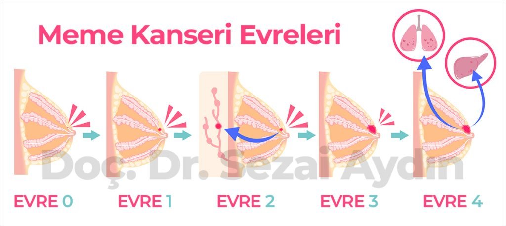 meme kanseri evreleri