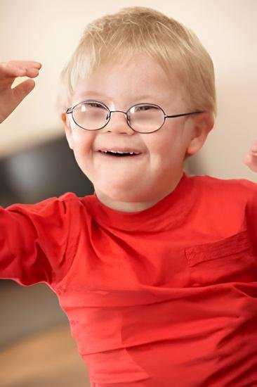 Down Sendromu 1 Down Sendromu