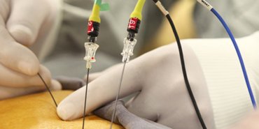 rf-radyofrekans-tedavi