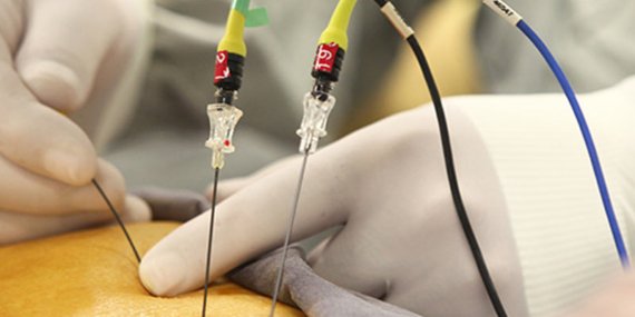 rf-radyofrekans-tedavi